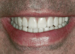 Figure 16 The patient's postoperative natural smile.