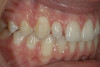 Fig 5. Short-span acetal resin implant provisional in place. (Photograph courtesy of Dr. David A. Little.)