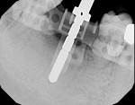 Figure 1 An indicator pin in an 8.5-mm osteotomy, showing about 4 mm to the canal on the radiograph.
