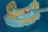 Fig 21. Occlusal view of the screw-retained implant crown.