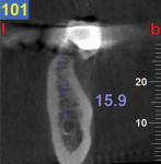 Figure 6 The cross member is removed, exposing the retention rails. A radiograph is taken with the guide in place. RIRs overlap, the radiograph is diagnostic, the trajectory is good, no adjustment is needed; use 0º, green rotation block.