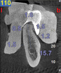Figure 7 CBCT of the same area; the patient now wears a VPS impression, which shows clearly the space taken by soft tissue. In addition, the outline of the desired crown is related to the bone and soft tissue.