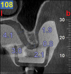 Figure 9 Visualization of the bone and soft tissue, but also the relationship with the maxillary sinus.