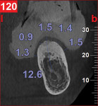 Figure 10 Considerable resorption rendered bone sounding inadequate for this case; CBCT with soft tissue visualization was required.