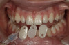 Fig 4. Short-span acetal resin implant provisional. (Photograph courtesy of Dr. David A. Little.)