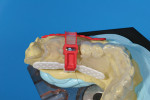 Figure 12 The wing assembly can translate and rotate to establish the desired mesiodistal position in relation to the neighboring tooth, while maintaining the correct buccolingual position.