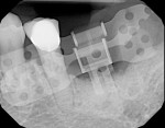 Figure 14 A periapical radiograph shows that the bucco and lingual RIRs overlap sufficiently to consider the image diagnostically adequate. The trajectory is as desired, so no rotational adjustment is needed; hence, a 0° (green) rotation block is selecte