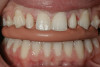 Fig 6. Esthetic overlay acetal resin removable partial overdenture.