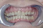 Figure 15 The mandible held forward. When the mandible is held forward with an appliance, the teeth are free to erupt and correction is possible.