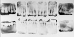 Figure 4 Case 2 pre-treatment radiographs showing advanced bone loss.