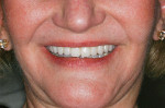 Figure 6  Case 2 post-treatment photograph showing satisfied patient who was initially difficult to please.