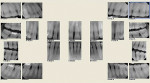 Figure 14  Case 6 preoperative radiographs showing bone loss.