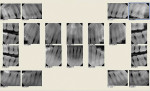 Figure 17 Case 6 postoperative radiographs, 4 months after LANAP.