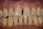 Figure 18 Case 6 post-treatment photograph, 4 months after LANAP.