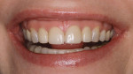 Figure 27 Case 9 pre-treatment photograph of patient’s smile.