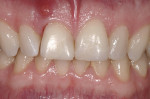 Figure 4 (Case 2) Pre-treatment photograph of the maxillary right central incisor with the root fracture and facial fistula.