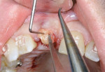 Figure 7 (Case 2) Placement of a CTG at the time of implant placement.