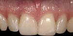 Figure 8 (Case 2) Intraoral photograph 5 years post-treatment.