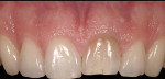 Figure 9 (Case 3) Pre-treatment photograph of patient with ankylosed left central incisor.