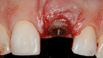 Figure 11 (Case 3) Treatment involved an implant, custom-healing abutment, CTG, and closure with 7.0 vicryl sutures.