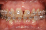 Figure 15 (Case 4) Seen here is the occlusal relationship and the improved osseous levels in the patient. The vertical defect has been greatly diminished.