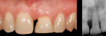 Figure 16 (Case 4) Seen here is the occlusal relationship and the improved osseous levels in the patient. The vertical defect has been greatly diminished.