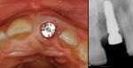 Figure 17 (Case 4) Radiograph at time of immediate implant placement.