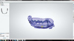 Figure 4 A putty index is created of the opposing dentition and scanned for occlusal references.