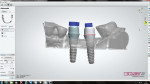 Figure 8 The software automatically begins the abutment-design process, and the technician then refines the design to tailor it to the specific clinical situation.