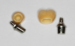 Figure 11 The BellaTek Abutments are returned to the dental technician—CAD/CAM BellaTek zirconia copings/crowns were fabricated to complete the case.
