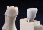Figure 3 Full-contour Zirlux™ molar with buccal cut back for porcelain and Pearl zirconium coping over a custom CAD/CAM abutment.
