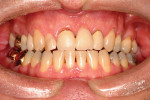 Figure 3 The patient following straightening and pre-restorative treatment.