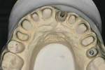 Figure 9 The zirconia abutments on the working model.