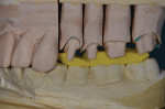 Figure 2 The maxillary bite record was trimmed to avoid tissue contact and allow full facial view.