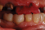 Figure 7 An intraoral duralay jig was made to be used as an occlusal record.