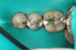 Figure 1 Preoperative intraoral photograph. Note the defective, leaking margins on the amalgam restorations.