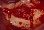Figure 14  Donor graft is removed from the retromolar area. Fixation holes were prepared before removing the graft.