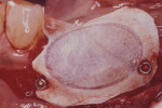 Figure 19  Occlusal view of the tori grafted into place.