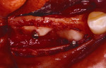 Figure 21  Gore-Tex nonresorbable membrane before removal at implant placement.