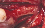 Figure 22  Augmented ridge before implant placement.