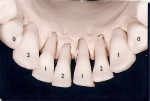 Figure 2  Implant distribution in mandible.