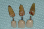 Figure 4  Extracted teeth.