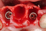Figure 5  Implant placement.