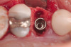 Fig 17. Crowns inserted with temporary cement.