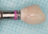 Fig 18. Final restoration in place that can be easily and predictably removed and serviced. The e.max® crowns will wear like enamel and do not need to be replaced like denture teeth.