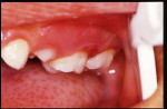 Figure 4  Marked erythema on distobuccal gingiva of maxillary left second primary molar (buccal view).