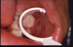 Figure 5  Distobuccal area presented 2 mm of gingival recession (occlusal view).