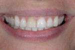 Figure 2  Close-up smile. Note high lip dynamics, diastema, and thin and broken incisal edge.