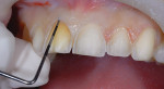 Figure 10  Probing of the labial gingival sulcus revealed a high crest relationship.