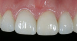 Figure 15  Postoperative 1:1 showing dark tooth and stump masked with porcelain and matching the adjacent veneer.